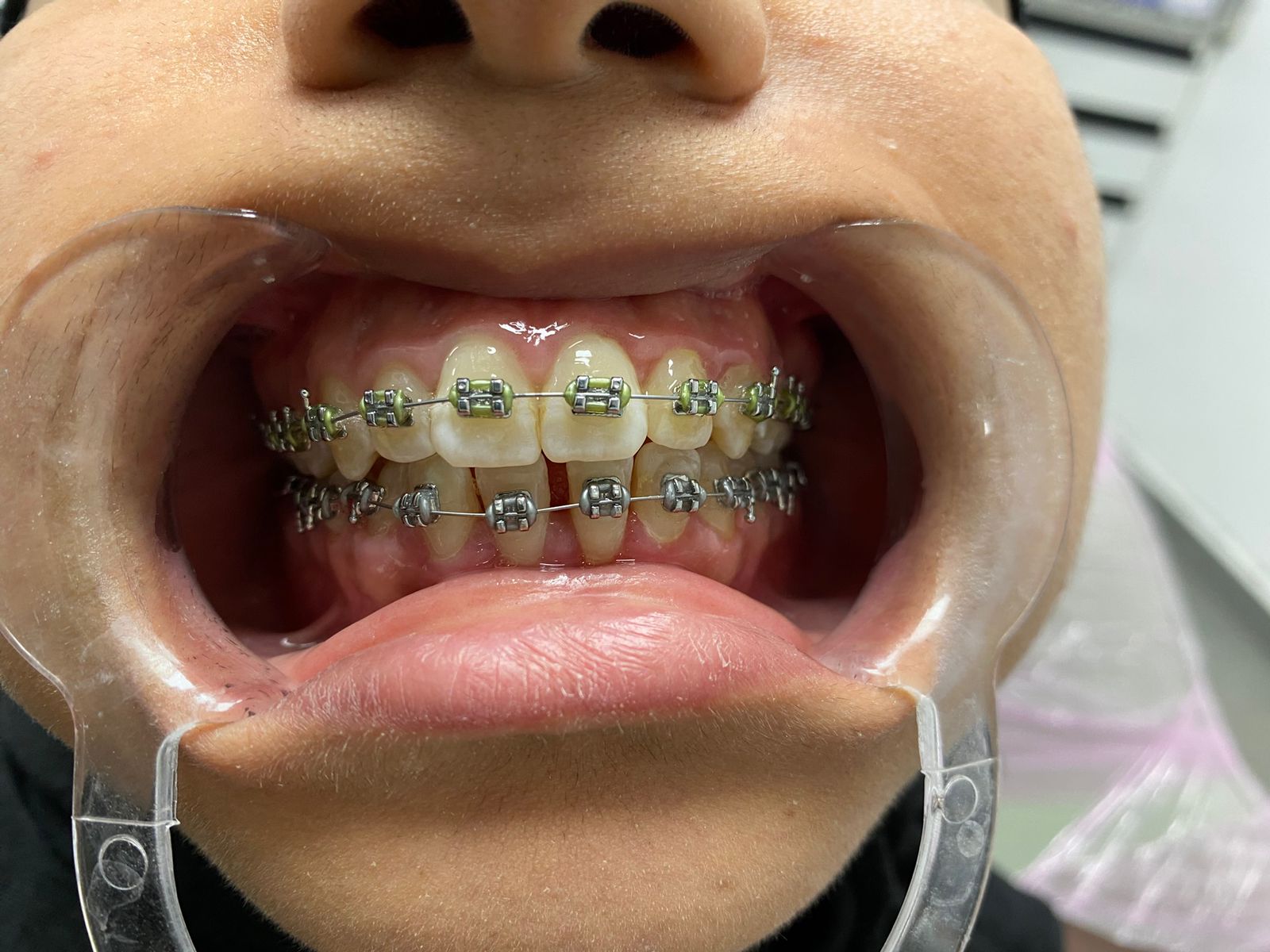Traitement orthodontique au Centre Dentaire Dr Moumen El Mehdi à Casablanca